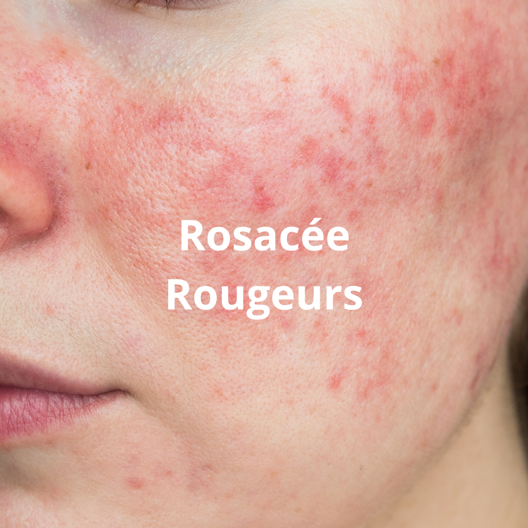 traitement de la rosacée et des rougeurs avignon